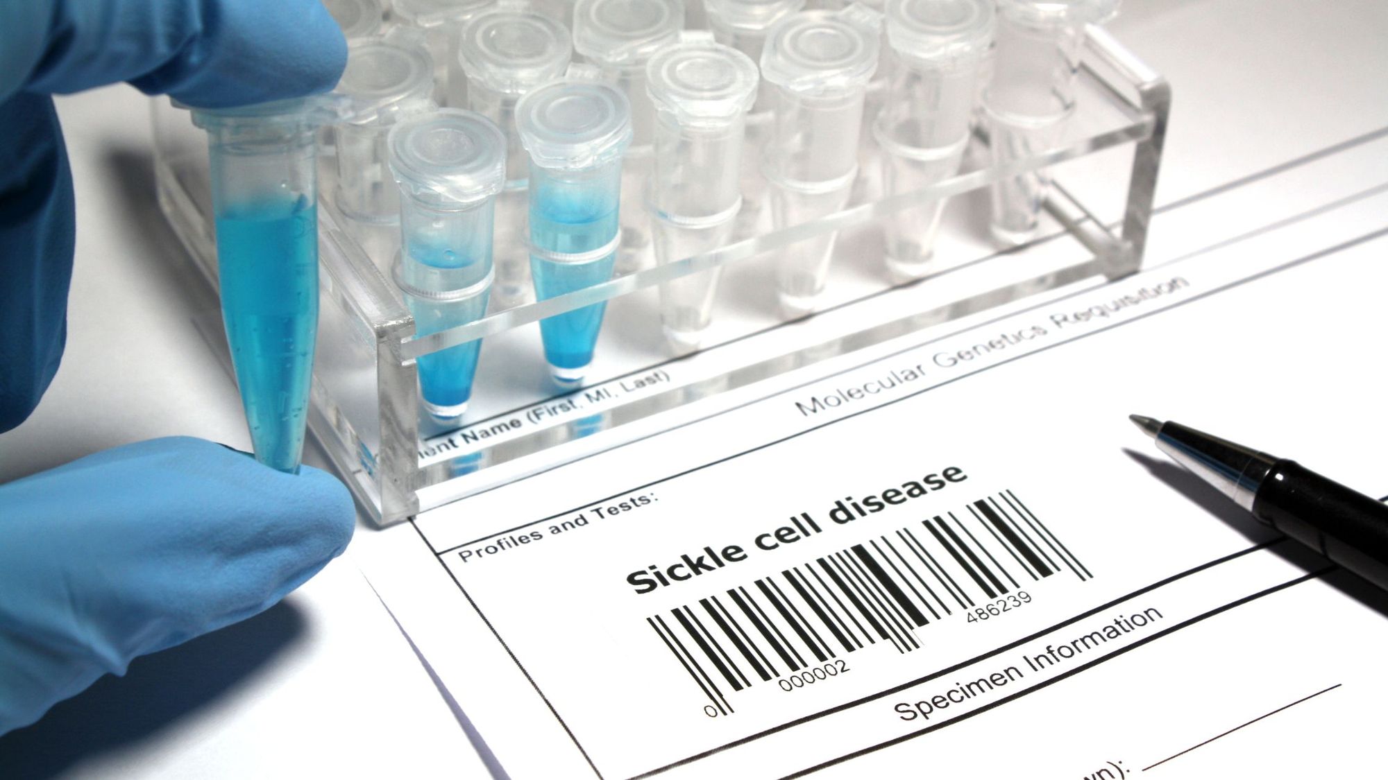 How is Sickle Cell Disease Inherited?