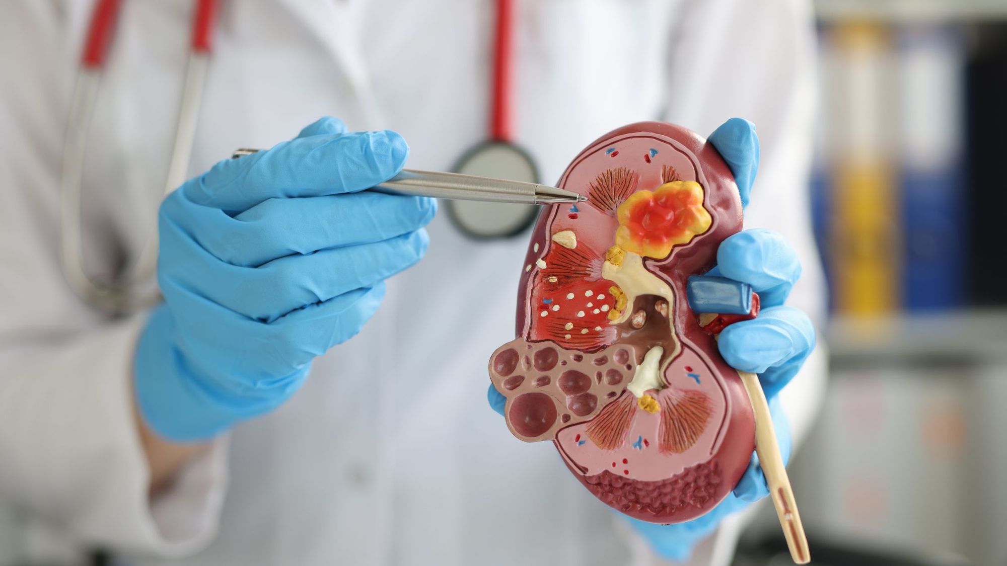 Kidney Stone Treatment and Prevention