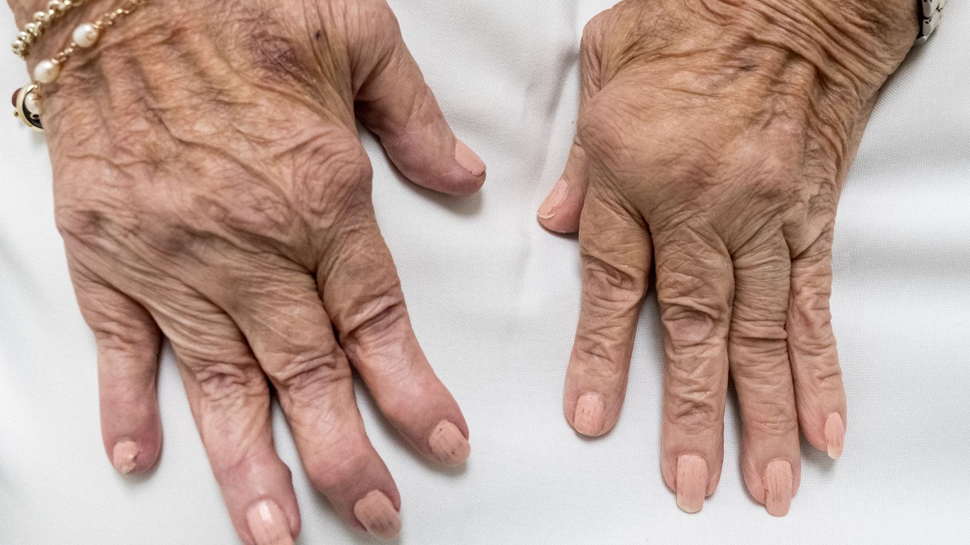 What is Rheumatoid Arthritis?