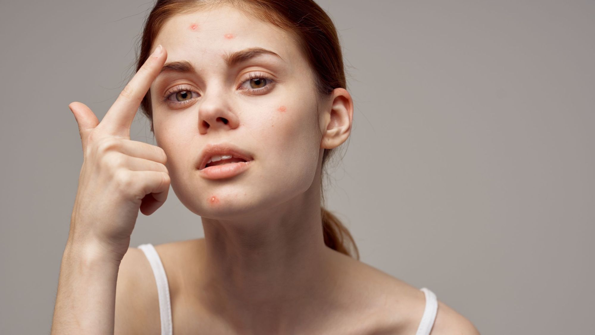 Adult Acne: Causes and Treatment