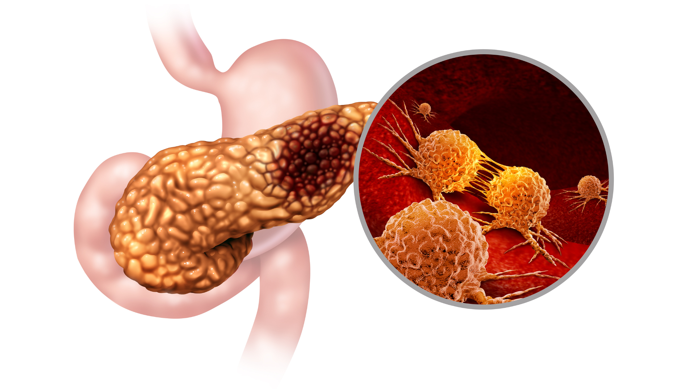 Why is Pancreatic Cancer so Devastating? Here’s What You Can Do