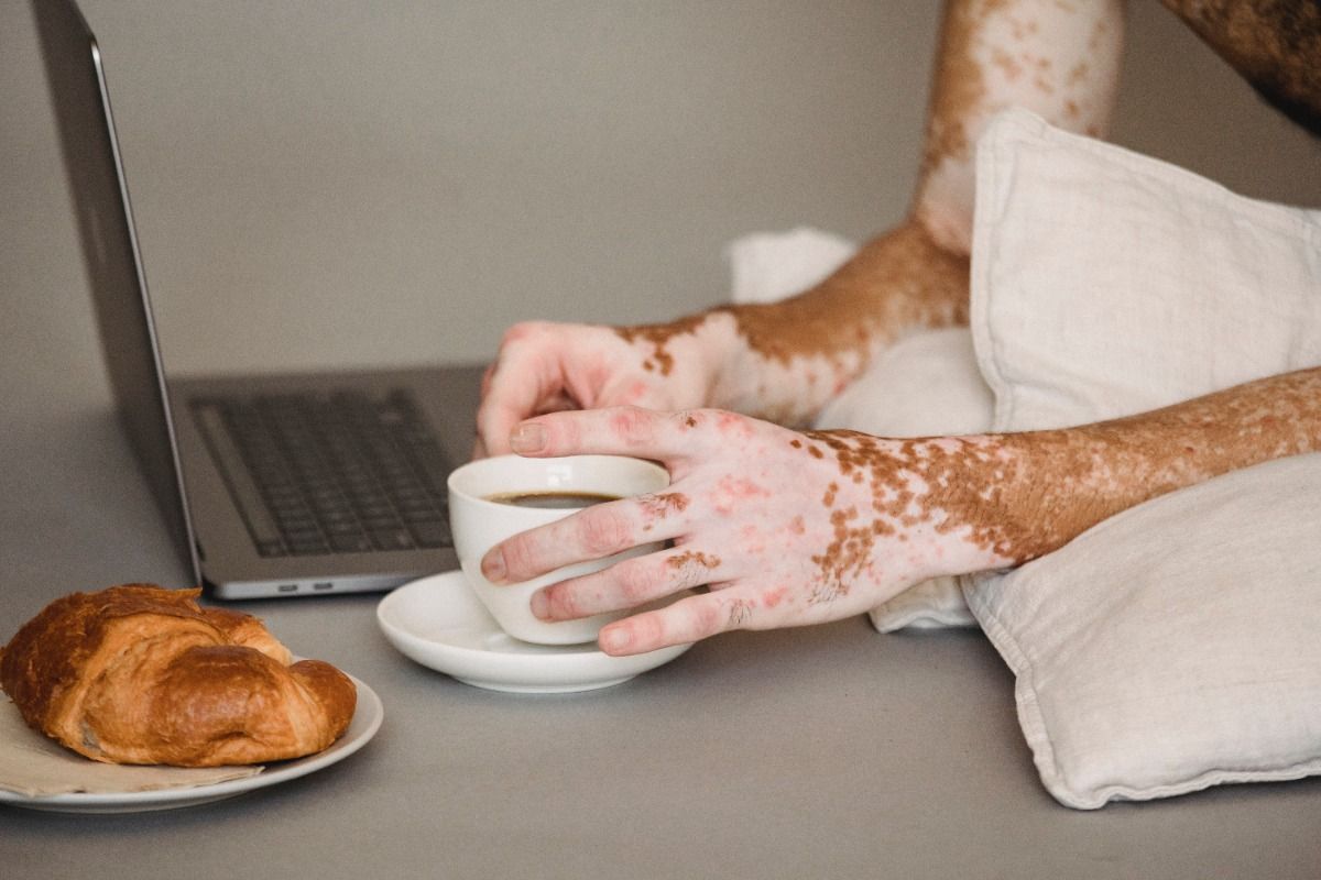Vitiligo: Signs, Symptoms and Treatment