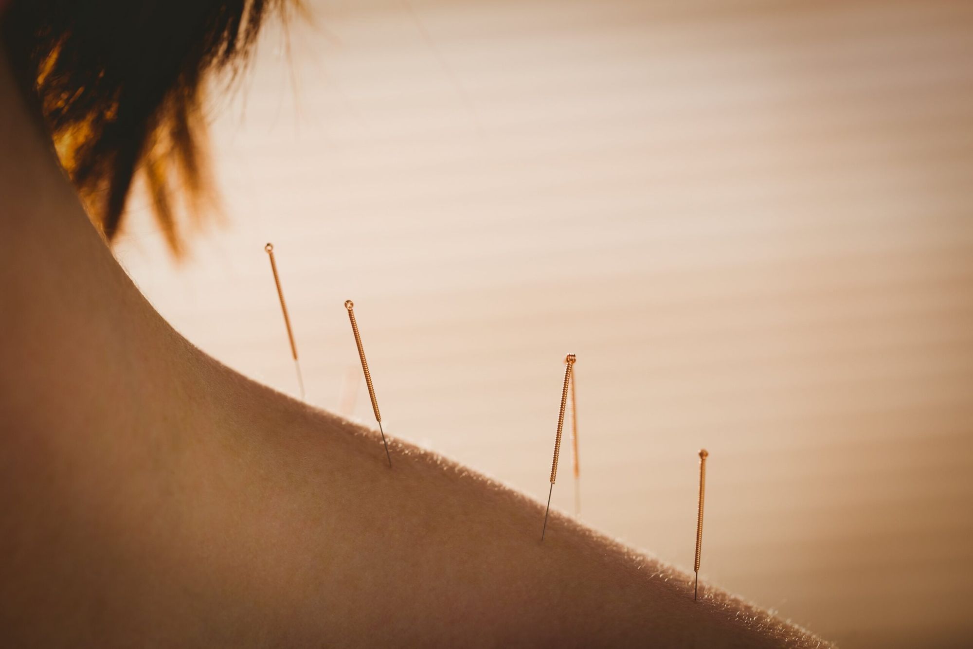10 Health Benefits Of Acupuncture