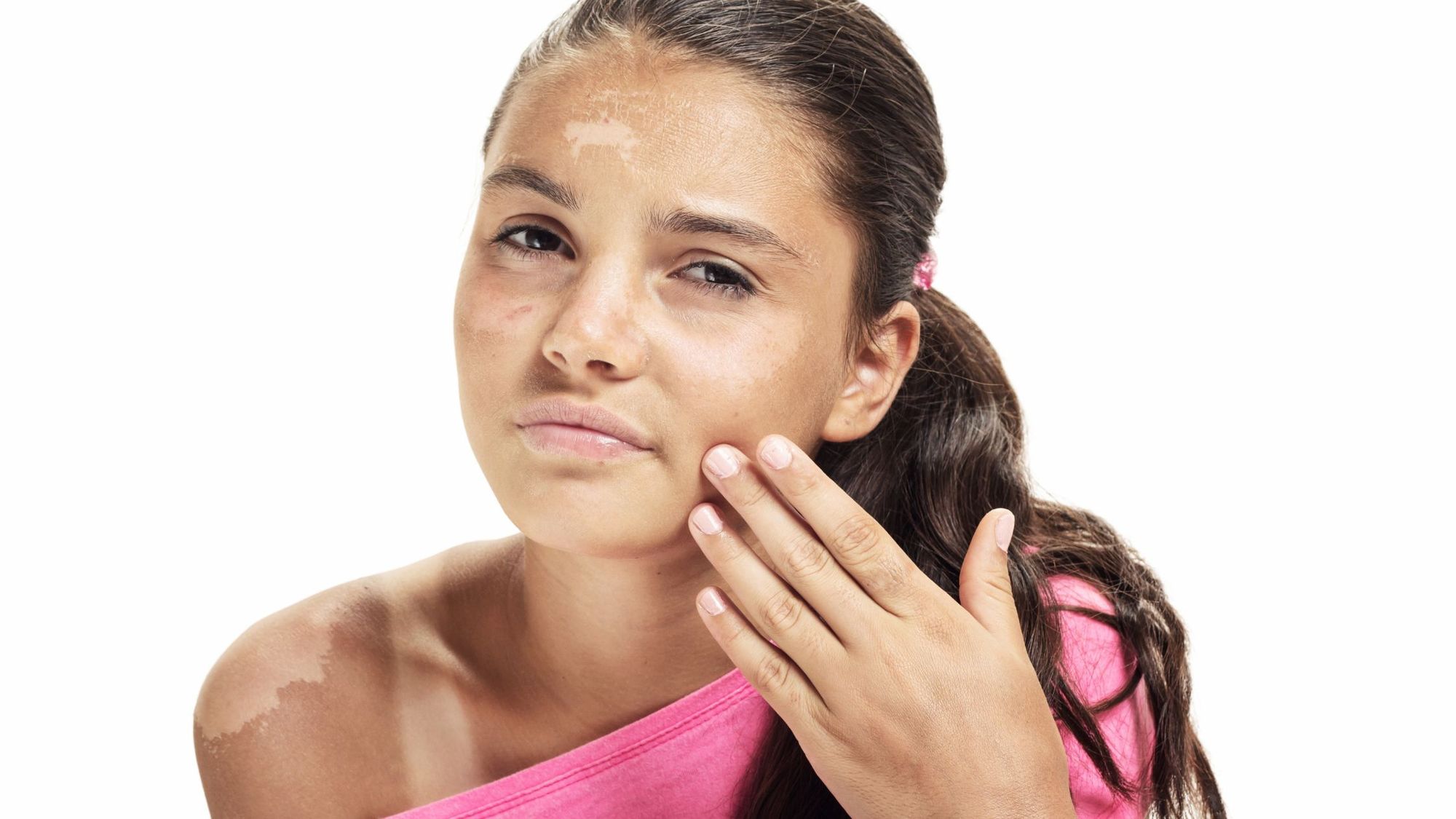 7 At Home Sunburn Relief Tips