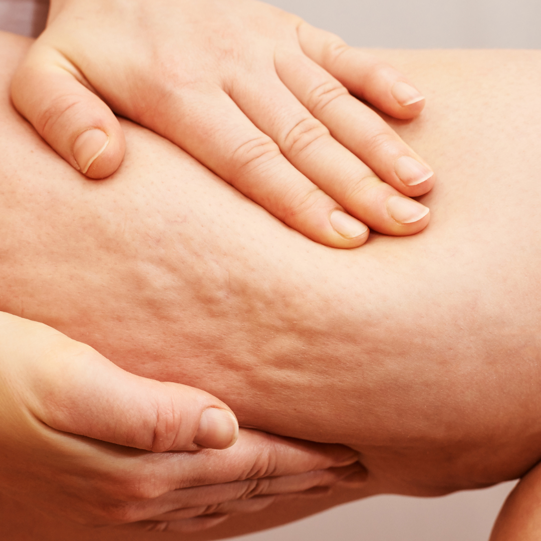 The Role of Genetics in Cellulite Development