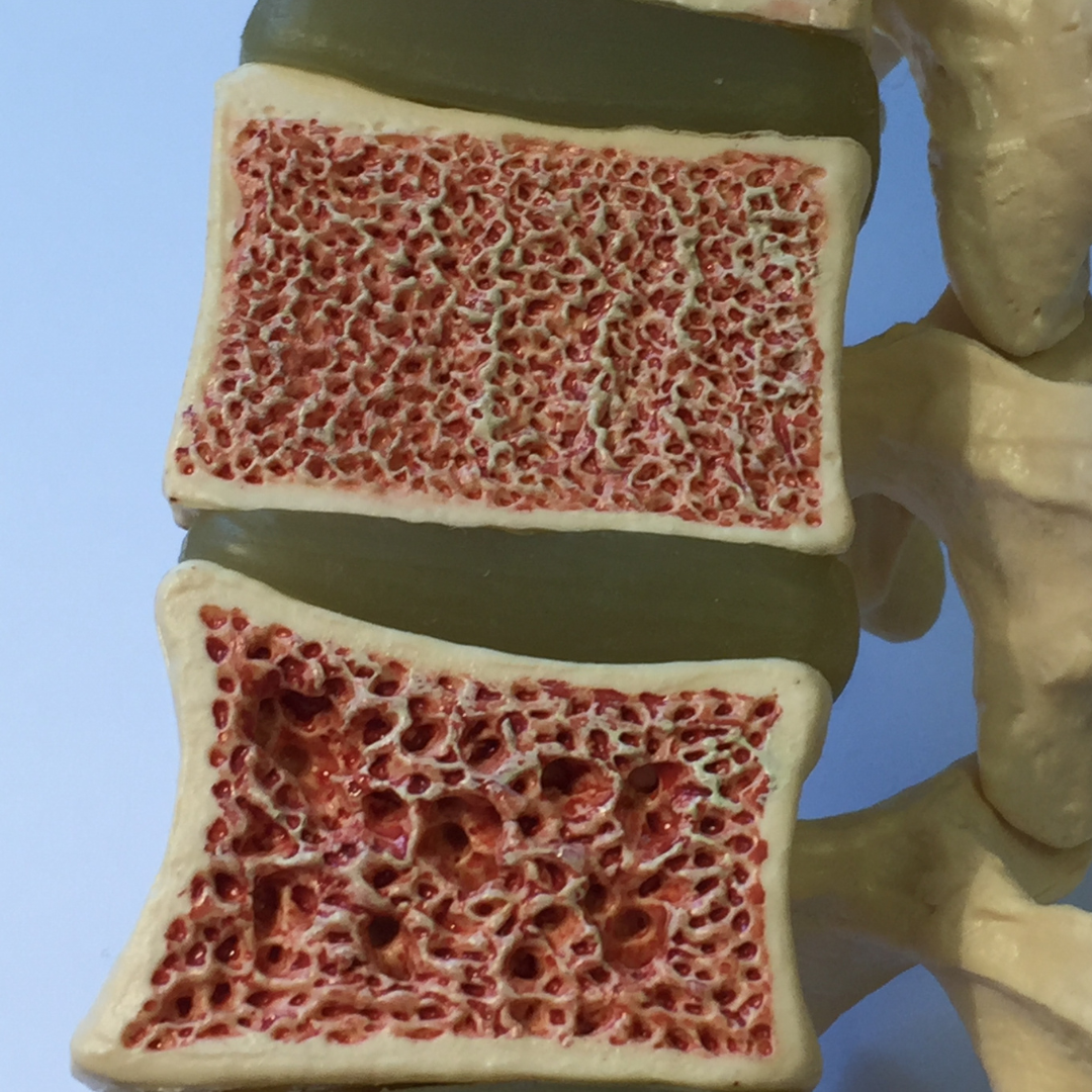 Understanding Osteopenia vs. Osteoporosis: What's the Difference?